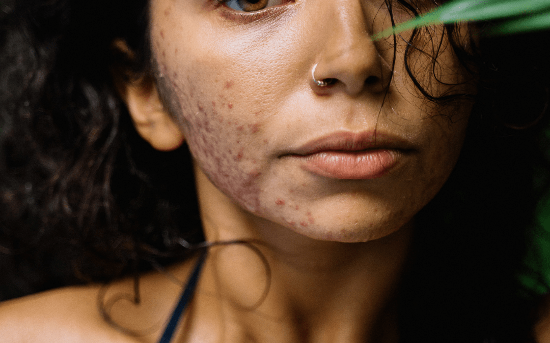 image acné hormonale expliquée